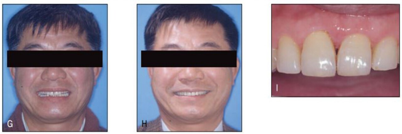 (그림 23-10) 치주 골지지 소실로 인해 심미적으로 불량한 소위 black triangle이 나타난 모습인데(A), 인접면 삭제를 통해 공간을 형성한 후 이를클로져함으로써 gingival squeezing에 의해 black triangle 크기를 감소시킬 수 있었다(B, C). 이후 과정출된 우측 중절치의 reshaping으로 심미적인 절단연 레벨링을 형성하였다. 치은연 레벨링을 위해서는 우측 중절치의 정출이 필요하지만 가철식 장치로는 불가하기도 하고 환자의 스마일라인이 낮아 심미적으로 큰 문제가 되지 않으므로 그냥 두었다(D-F). 교정치료로 환자의 self image가 크게 증진된 것을 볼 수 있으며 교정치료결과 또한 안정적으로 유지되었다(G-I)