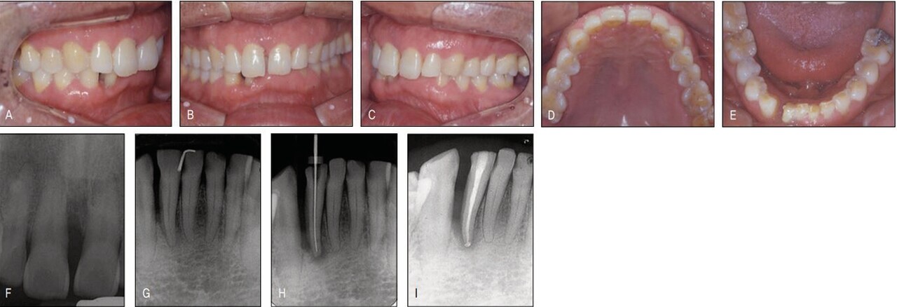 (그림 23-7)  PTM으로 인해 공간 재분배 교정이 필요하나 비심미적 교정 장치로 인해 교정치료를 꺼리는 고령 남자 환자 증례. 상악은 10년 전부터 서서히 공간이 생겼다고 진술한 반면, 하악은 급작스러이 우측 측절치 원심에 심한 공간이 일년 전에 발생하였다고 하였다. 지난 치과 병력을 보니 근관-치주 복합병소에 의한 농양으로 PTM이 심하게 나타난 것이었다. 이로 인해 정상적인 보철치료가 불가하여 공간 재분배를 위해 의뢰되었다