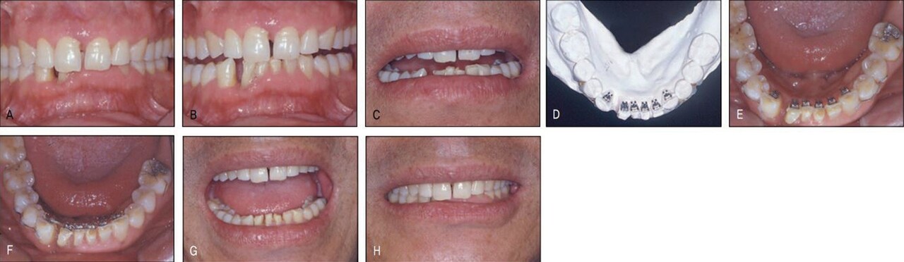 △   (그림 23-8)  하악 교정 외에도 비심미적인 정중 공간 클로져를 위한 상악교정도 필요하나 환자는 보철을 위해 꼭 필요한 하악에서의 교정만 하는 것으로 하고 상악 치료는 거부하였다(A~C). 과개교합으로 인해 순측부착이 불가하여 설측으로 장치를 부착하고 한 개의 와이어를 사용하여 간단히 치료하였다(D~F). 하악교정 후 환자에게 다시 상악 교정을 권유하였더니 환자는 흔쾌하게 상악도 교정을 하겠다고 하였다. 하악에서처럼 심미적 교정장치로 치료 받을 수 있을 것으로 기대했기 때문이었다(G, H)