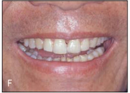 (그림 23-9)  상악에서는 투명교정장치를 이용하여 치료하였다. 설측교정은 과개교합으로 인해 불가하기도 하지만 PTM이 나타난 환자의 특성상 투명교정장치가 환자 뿐 아니라 술자에게도 훨씬 편리한 장치가 될 수 있는 증례이기 때문이었다. 상악에 장치를 낀 모습인데 매우 심미적인 것을 볼 수 있으며 교정치료를“민망해 하는”고령 환자들에게 큰 도움이 될 것으로 기대할 수 있다.