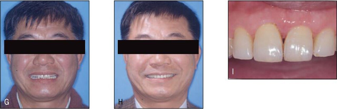 △   (그림 23-10)   치주 골지지 소실로 인해 심미적으로 불량한 소위 black triangle이 나타난 모습인데(A), 인접면 삭제를 통해 공간을 형성한 후 이를클로져함으로써 gingival squeezing에 의해 black triangle 크기를 감소시킬 수 있었다(B, C). 이후 과정출된 우측 중절치의 reshaping으로 심미적인 절단연 레벨링을 형성하였다. 치은연 레벨링을 위해서는 우측 중절치의 정출이 필요하지만 가철식 장치로는 불가하기도 하고 환자의 스마일라인이 낮아 심미적으로 큰 문제가 되지 않으므로 그냥 두었다(D-F). 교정치료로 환자의 self image가 크게 증진된 것을 볼 수 있으며 교정치료결과 또한 안정적으로 유지되었다(G-I).