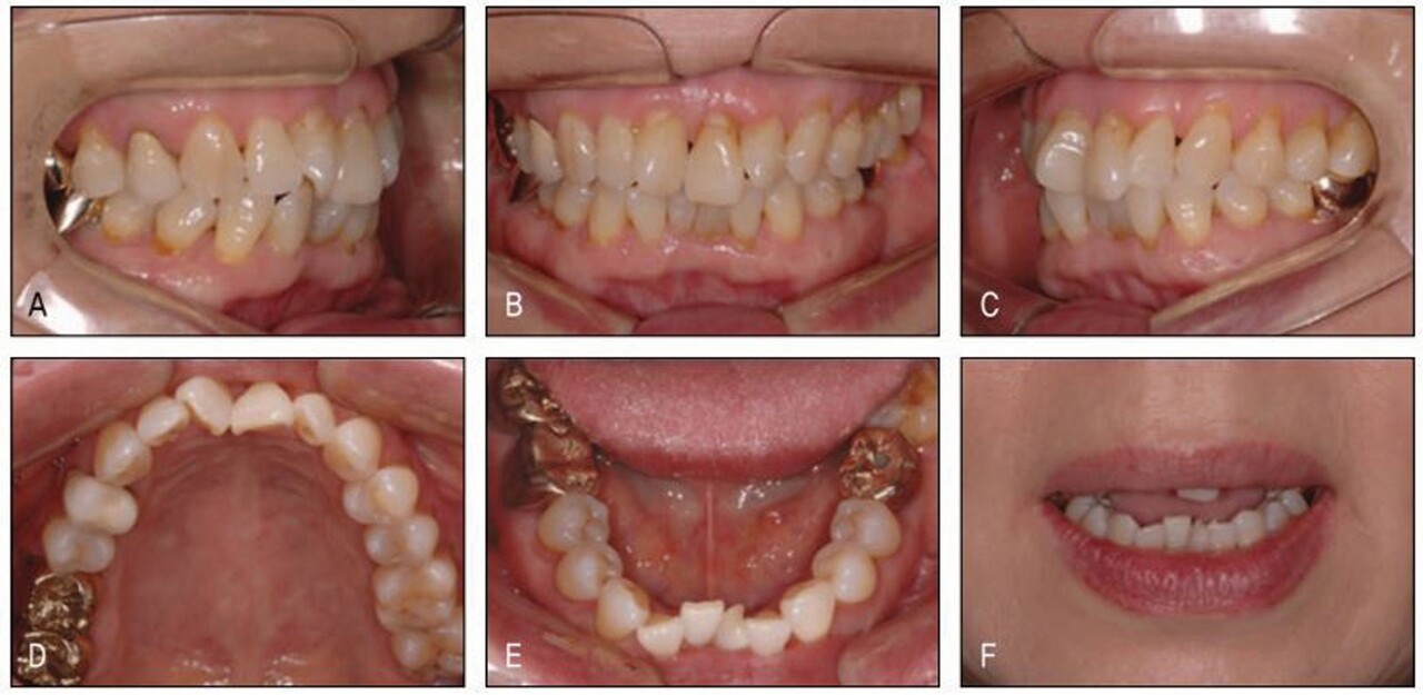 (그림 23-17) 구치부 교합은 양호하나 전치부에서의 심한 크라우딩으로 평소 교정치료 하기를 간절히 바래왔던, 그러나 치료 시 동통이 무서워 교정치료를 주저하였던 환자가 교정치료 시 통증이 적은 장치가 개발되었다는 이야기를 듣고 내원하였다.