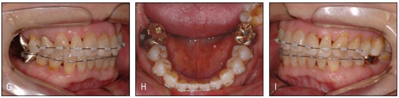 (그림 23-18) 약한 힘으로 교정하기 위해 미니튜브를 부착하고 012 NiTi를 이용하여 치료를 하였다. 스트리핑을 시행한 결과 크라우딩이 펴지면서 흔히 나타나는 비심미적 현상인 black triangle을 최대한 줄 이는 부수적인 효과도 얻을 수 있었으며 무엇보다 교정치료 중 동통이나 불편감이 없어 환자는 매우 만족해 하였다.