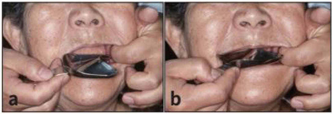 (그림 4) 상악 트레이를 시적하는 방법. a) → d) 시계 반대방향으로 돌리면서 구강 내에 넣는다.