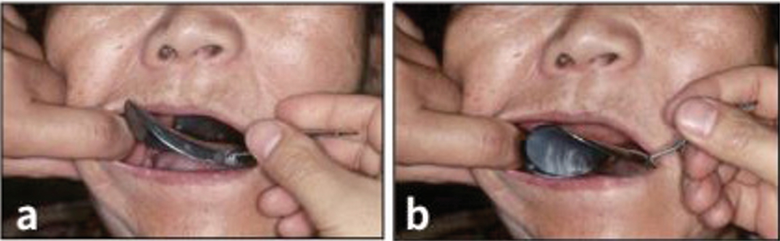 △ (그림 5) 하악 트레이를 시적하는 방법. a) → d) 시계 방향으로 돌리면서 구강 내에 넣는다.
