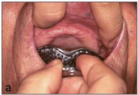 (그림 8) 상악 인상채득법. a) ) Labial frenum을 확인 후 전방부를 seating 시키고