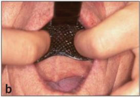 (그림 8) 상악 인상채득법 b) 구치부위를 seating 시킨다