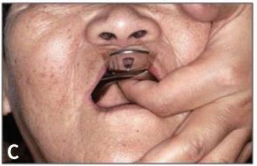 c) Compound가 굳을 동안 tray를 고정한다.