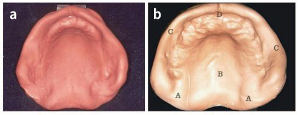 △  (그림 9)  a) Compound 상악 인상，  b) 상악인 상에서의 해부학적 구조. A, Hamular notch； B, Foveae palatinae； C, Notch for buccal franae； D, Notch for labial frenum. (Neil  and  Nairn,  Complete  Denture Prosthetics, Wright, 1990.)