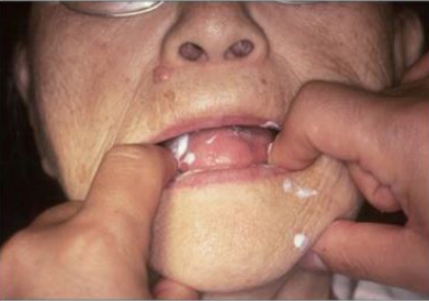 △ (그림 12) 트레이를 구강 내에 seating시키고 혀를 전방으로 내밀게 한 후 트레이를 고정하는 모습