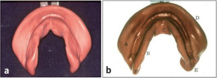 △ (그림 13) a) Impression compound에 의한 하악 인상, b) 하악인상에서의 해부학적 구조. A, External oblique ridge에 의해 형성된 groove; B, Mylohyoid muscle 수축에 의한 depression C, Lingula frenum D, Labial 과 buccal fraena; E, Postmylohyoid fossa. Neill and Nairn, Complete Denture Pros- thetics, Wright, 1990.