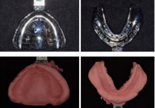 △ (그림 16) 상) 무치악용 상하악 트레이, 하) 상하악 Alginate 1차 인상.