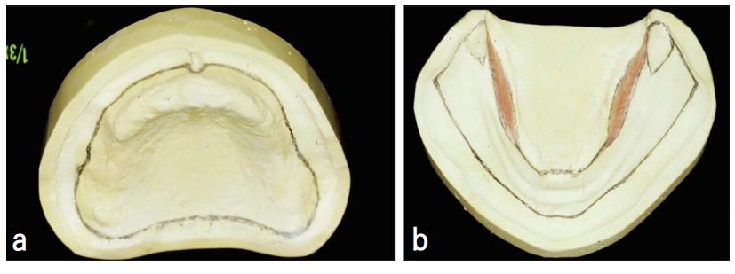 △ (그림 18) a) 상악 individual 트레이의 outline,  b) Mylohyoid muscle 부위가 wax로 2mm relief된 하악 individual 트레이의 outline.