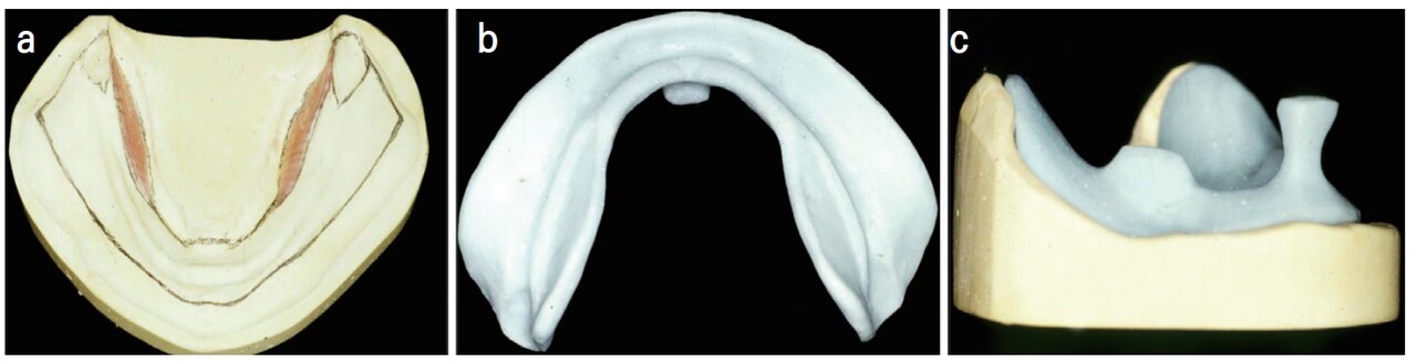 △ (그림 20) 하악 개인용 트레이. a) mylohyoid muscle 부위는 mylohyoid muscle의 contraction을 수용하기 위하여 Base plate wax 한장 정도로 relief 해준다, b) mylohyoid muscle의 contraction을 수용 가능한 트레이 조직면, c) 중앙과 소구치 부 손잡이.