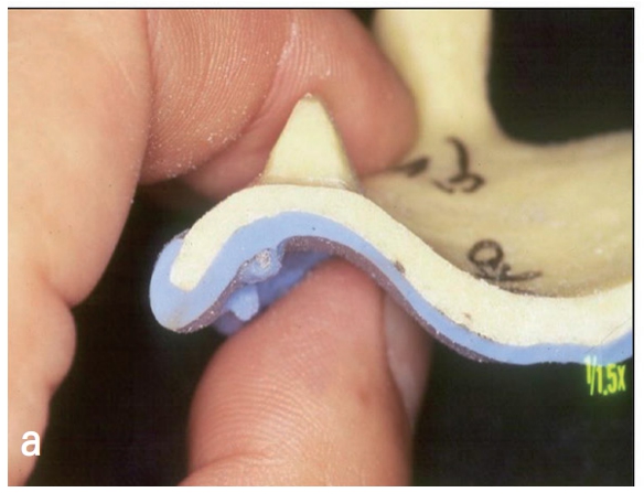 △ (그림 21) 의치상 변연부가 최종 인상 채득 시 인상 재에 의해 border moulding이 완성된 모습