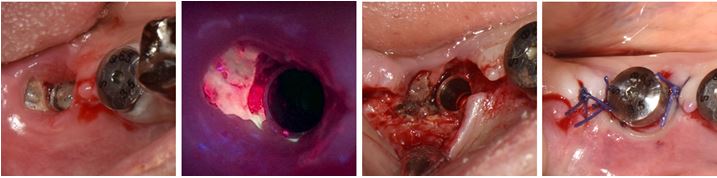 그림 1. 형광유도 MRONJ 수술기법을으로 MRONJ 병소에 이환된 치아 및 임플란트를 보존하는 최소침습적이면서 효과적인 수술기법을 제시하였다. (Photodiagnosis Photodyn Ther. 2024;50:104370)