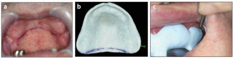 △ (그림 22) 개인용 트레이의 retention을 check한다. a) Vibrating line을 표시한다. b) 트레이를 구강 내에서 맞춰 보아 후방 연장을 확인한다. 이 부위까지 트레이가 연장되어야 한다. c) Labial 및 Buccal frenum부위의 check-up, sulcus reflection 보다 조금 짧은지 확인한다.