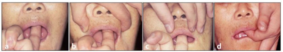 △ (그림 24) a) 트레이 seating후 우측 검지로 고정한다, b) bucal flange를 위해 border moulding을 한다. c) labial frenum 부위 의 border moulding을 위해 상순을 아래로 내려준다. d) 인상재가 굳을 때까지 고정해준다.