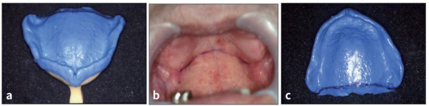 △ (그림 25) a) 상악의 Medium body silicone 인상재 최종 인상 b) 구개부위 vibrating line c) 인상체에 vibrating line을 표시한다.
