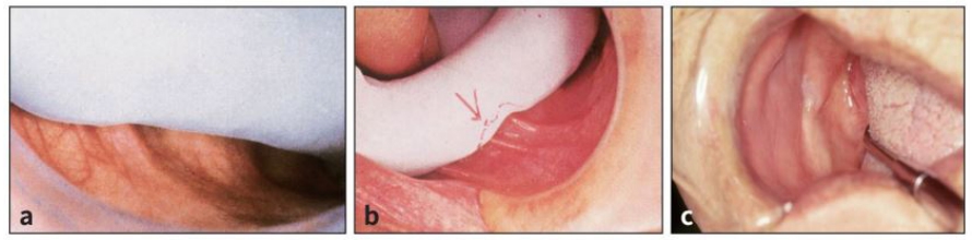 △ (그림 26) 개인용 트레이를 구강내에 시적해 본다. a) Tissue reflection point 까지 연장을 확인한다. b) Frenum 부위 과연장된 부위는 den- ture bur로 삭제해 준다. c) Retromylohyoid space를 확인한다.