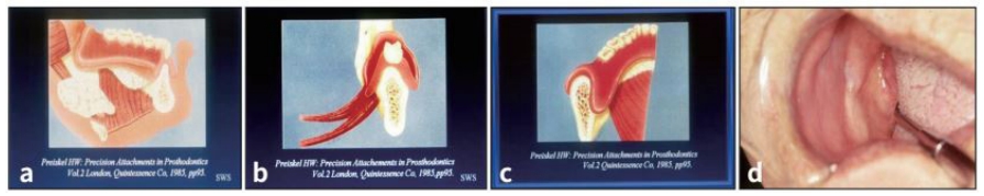 △ (그림 27) 하악 denture base의 인접 주요조직과 위치관계를 보여줌. a) 하악골을 cross-section한 것으로 rest 상태와 swallowing시 my-lohyoid muscle과 hyoid bone의 위치를 보여준다.b) Rest상태와 swallowing시 하악 dentrure의 lingual flange의 하연과 mylohyoid mucle의 관계를 보여준다. c) 하악 denture base가 mylohyoid muscle의 뒤쪽으로 연장되어 있다. d) Retromylohyoid space.