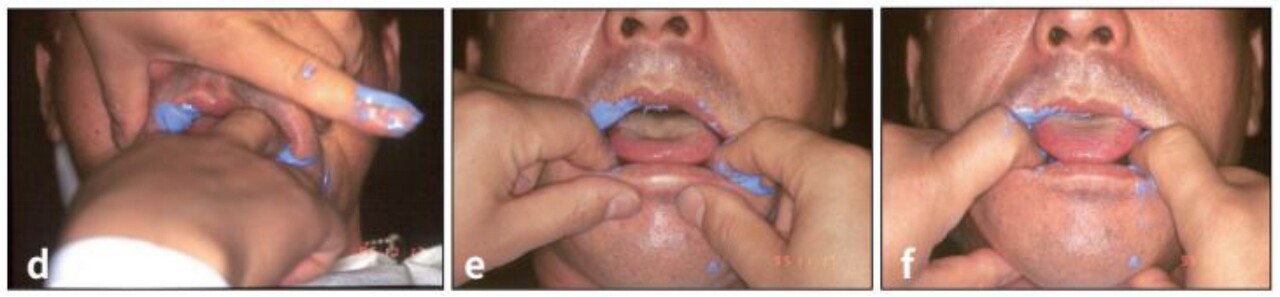 e) labial frenum 부위를 activation 시켜주고, f) 혀가 protrusion 된 상태에서 인상제가 setting 될 때까지 트레이를 고정해준다.