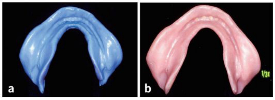 △ (그림 29) a) Mylohyoid muscle의 수축과 retromylohyoid fossa의 정확한 인지를 볼 수 있다, b) 완성된 총의치 의치상.