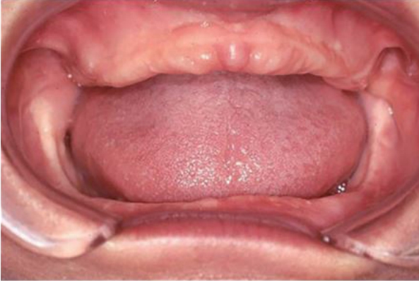 △ (그림 30) 무치악 환자의 구강상태. 상하악의 관계는 3차원적인 관 계이며, 수직적인 관계(Vertical jaw relation)와 수평적인 관계 (Horizontal jaw relation)는 전후(Anterior-Posterior), 좌우(LeftRight) 관계가 정립 되어져야 한다.