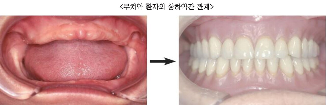△ (그림 31) 무치악 환자의 기능회복(Rehabilitation)을 위해서는 우선 교합평면을 설정해주어야 하고, 상하악 간의 3차원적인 중 심위 악간관계가 결정되어야 하며, 이러한 악간관계 하에서 인공치아의 중심위 교합(Centric occlusion)이 형성되어져야 한다.