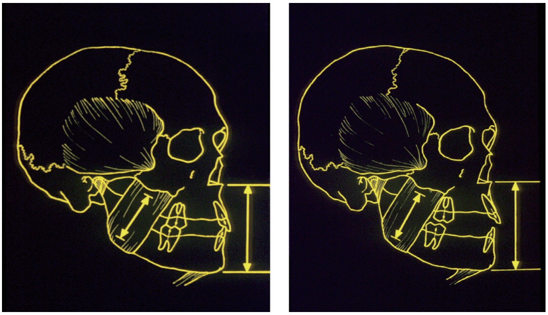 △ (그림 32) 자연 치열에서 Rest position에서는 상하악 치아가 소구치 부위에 서 약 2mm 정도 이개가 된다.
