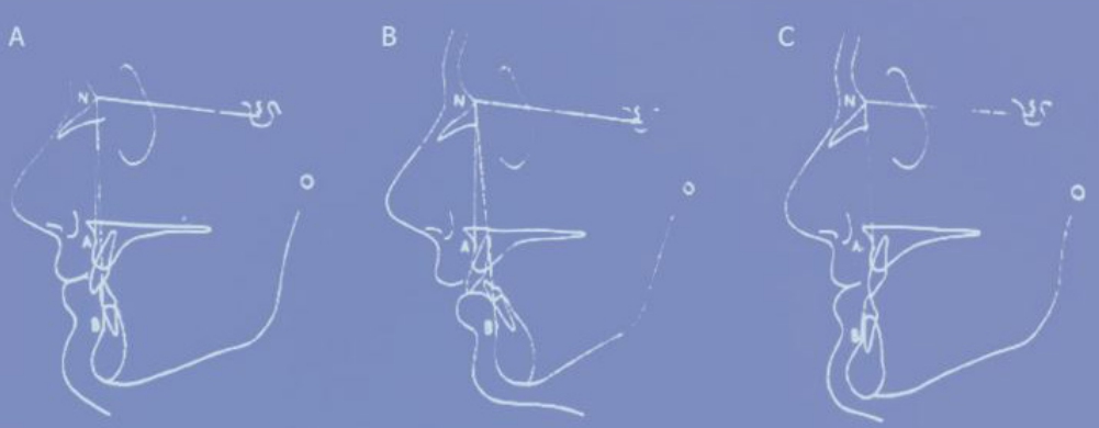 △ (그림 33) Kennedy 부정교합 분류에 따라 Interocclusal rest space의 평균치가 다르다. (A) Class Ⅰ (2~4mm). (B) Class Ⅱ (4~6mm). (C) Class Ⅲ (1~3mm)