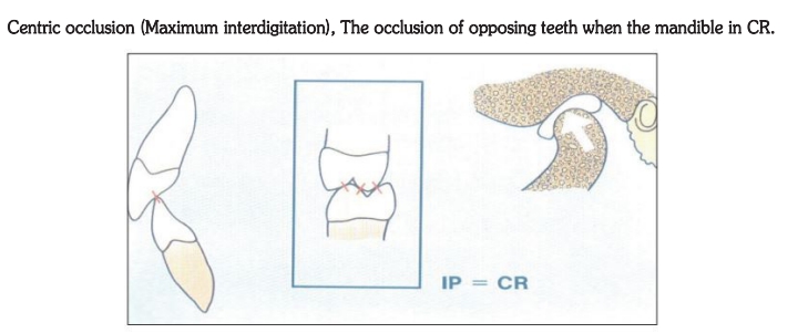△ (그림 34) 무치악 환자에서 하악 과두가 optimal condylar position인 Centric Relation 상태에서 치아가 Intercuspal position이 되도록 상하악의 수평관계를 결정해 주어야 한다.