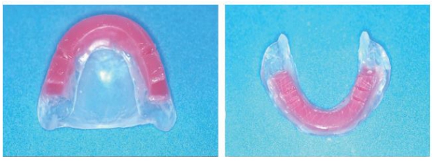 △ (그림 35) 악간관계 채득을 위한 상하악 Record base 위에 형성된 Wax Occlusion Rim.