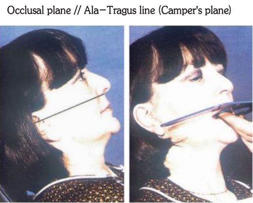 △ (그림 36) 일반적으로 성인에서 Camper's plane (Naso-Tragus line)과 Occlusal plane은 평행을 이룬다.