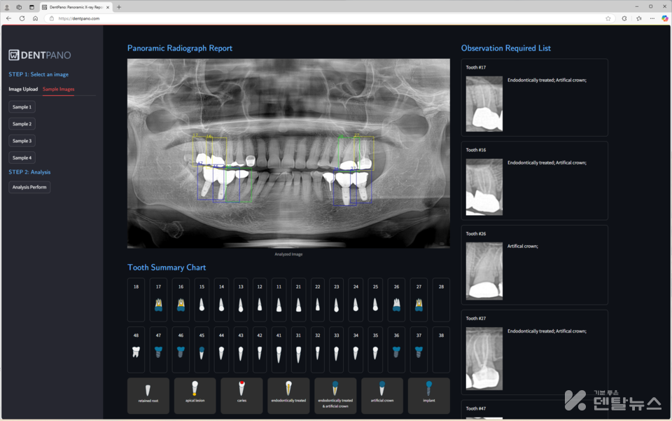 이기선 교수가 개발한 웹서비스 예시 - 치과 파노라마 엑스레이를 입력 하여 개별치아를 인식 및 관찰 필요 치아를 인식 후 기본적인 차팅(하단)과 관찰 필요치아를 고해상도로 확대하여 사용자에게 안내(우측) 하는 시제품 화면