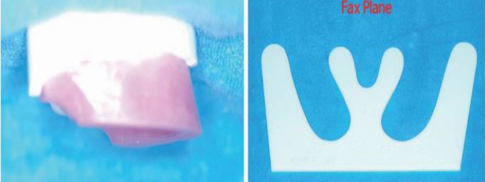 △ (그림 37) Wax rim의 좌우 경사도나 교합평면을 평가하는 데에 Fax Plane이 유용하다.