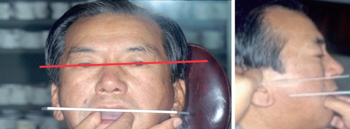 △ (그림 38) Fox plane을 이용하여 양측 Pupil line과 교합제의 좌우측 교합평면의 평행관계를 먼저 평가하고 교합제를 수정해 주어야 하며, 교합제의 전후방 경사도가 Ala-Tragus line과 평행관계를 이루도록 조절해주어야 한다.