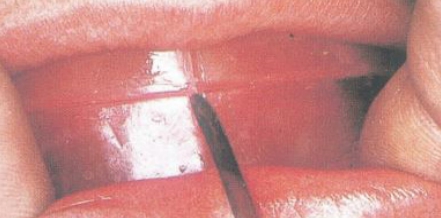 △ (그림 39) 환자의 안면의 중심선과 일치하도록 상하악 wax rim에 중심선의 표시해둔다.