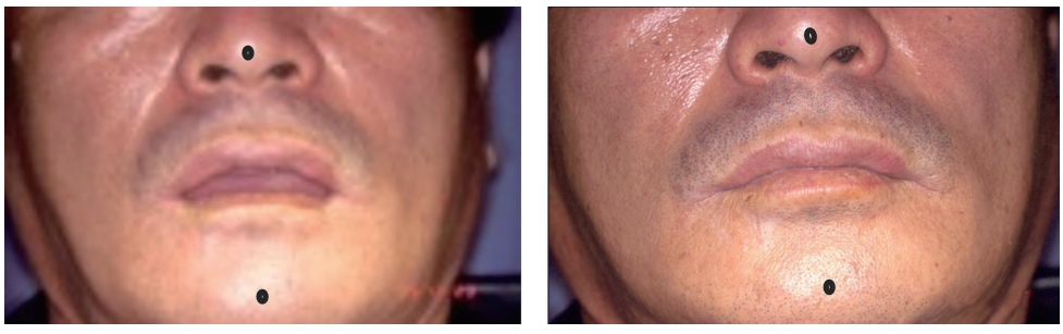 △ (그림 41) 안면의 수직고경을 측정하는 기구. Ruler, Compass, Willis Gauge, Dakometer