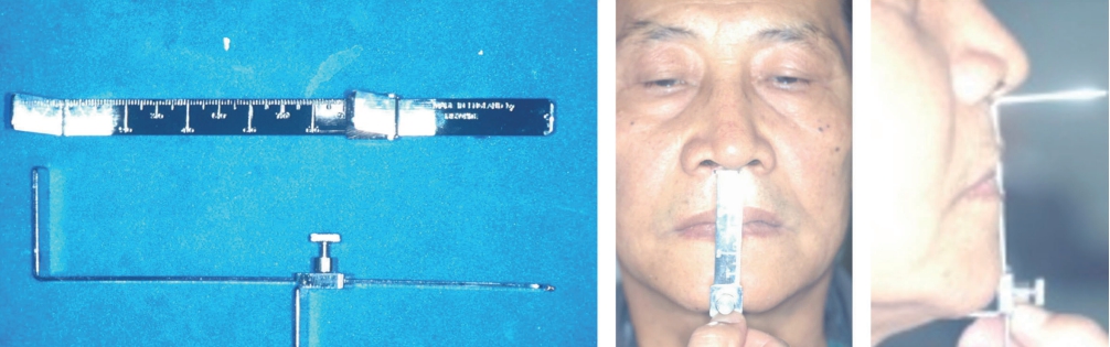 △ (그림 42) Willis gauge와 Willis gauge의 사용 방법. Vertical Dimension(수직고경)의 측정을 위해 환자에게 Willis gauge를 측면에서 측정해야 연조직의 눌리는 정도가 비슷하게 적용할 수 있다