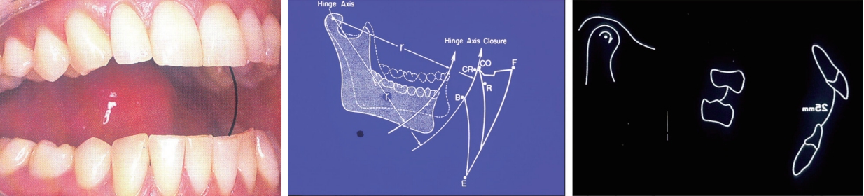 △ (그림 41) 하악 과두가 Hinge-like movement. 과두가 하악와의에 있고, 악골 근육들이 이완되어 있을 때에는 약 25mm 이내의 개 구 운동을 유도할 때 하악골을 simple hinge 같이 운동시킬 수 있다.
