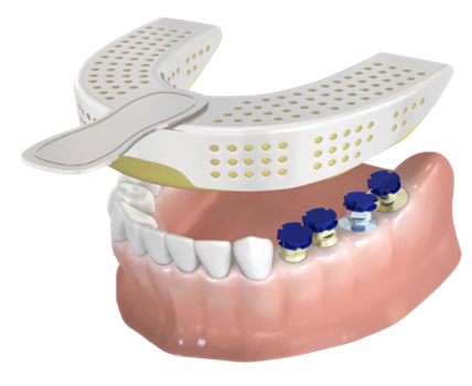 네오바이오텍의 PickCap Impression Coping