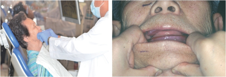 △ (그림 44) Hinge-like movement 및 centric jaw relation 채득 모습. 환자에게 침을 삼키며 입을 다물라고 요구하며 jaw relation record를 채득할 수 있다.