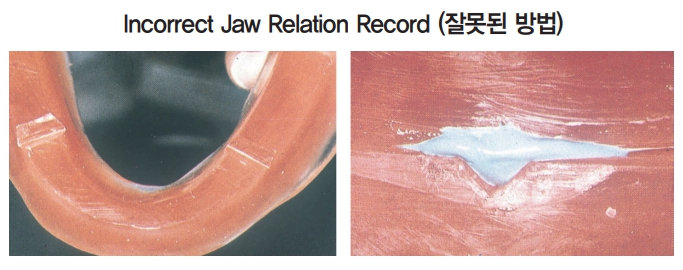 △ (그림 47) Jaw relation record를 채득할 때 위 그림과 같이 교합제의 일부분만 교합인기제를 적용하면 안되며 아래 그림과 같이 교합제 전체 에 교합인기제를 적용 후에 상하악 악간관계를 채득해야 한다.