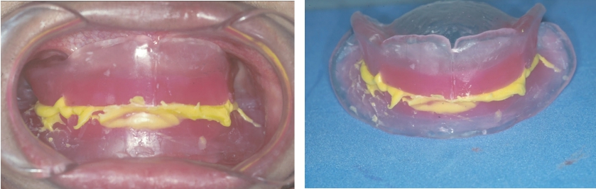 △ (그림 48) Bite registration material에 의해서 악간관계 채득이 완성된 record base와 waxrim.