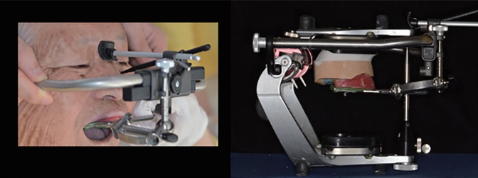 △ (그림 49) ace-bow record와 jaw relation record를 이용하여 무치악 상하악 cast를 Semi-adjustable articulator에 mouting 해준다.