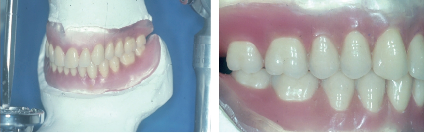 △ (그림 50) 교무치악 환자에서 상하악 edentulous cast가 centric jaw relationship 상태에서 최대감합위인 centric occlusion으로 도치 배열해주는 것이 이상적인 총의치의 교합개념이다.