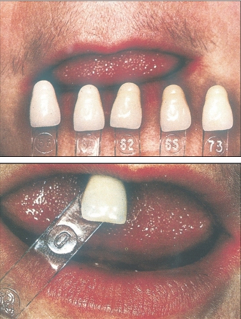 ▷ (그림 52) 인공치아 shade의 선택 시 Shade guide를 윗입술 안에 위치시켜 평가해야 한다.