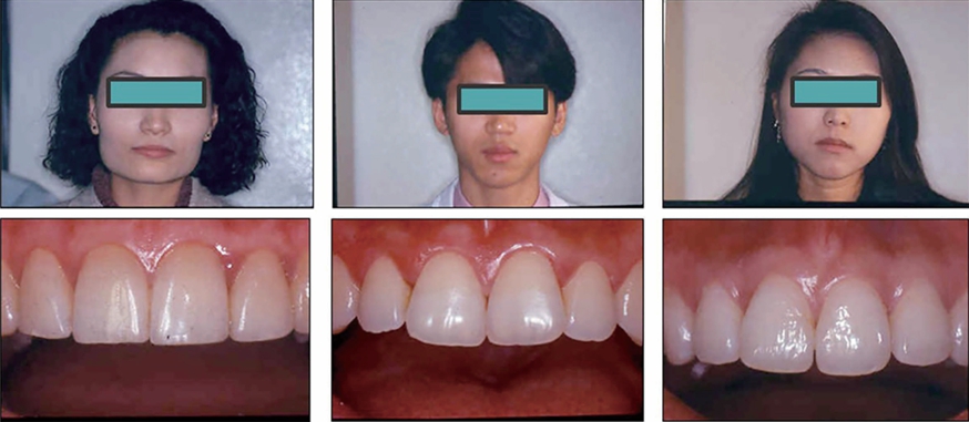  (그림 54) 안면 3 부위(이마 전방부, 관골부, 입술부위의 안면폭경)의 비율을 고려한 치아 비율의 선택. Square, Tapered, Ovoid type으로 구분할 수 있겠다