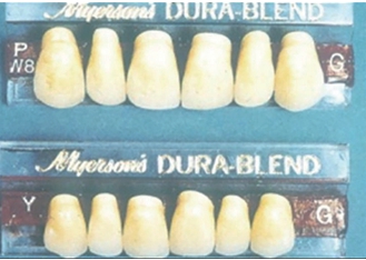 ◁  (그림 55) 코의 폭경과 6전치 폭경(양측 canine tip간의 폭경)과의 관계. 악궁의 형태(Square, Tapered, Ovoid type)에 따라 다르며, 악궁이 ovoid type이면 다음과 같은 공식이 성립된다(Distance of both Canine tips = Nose(Ala) width + 3~4mm).